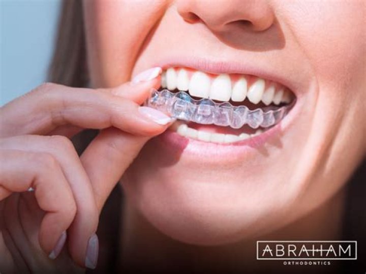 Straight Teeth Aren’t Only About Having a Pretty Smile – The Advantages of Invisalign Braces